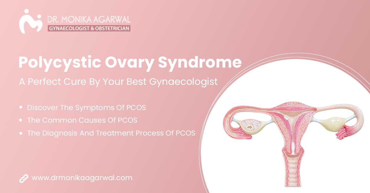Polycystic Ovary Syndrome – A Perfect Cure By Your Best Gynaecologist