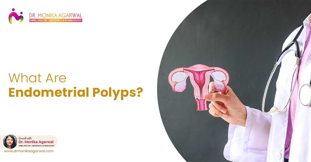 What You Need To Know About Endometrial Polyps